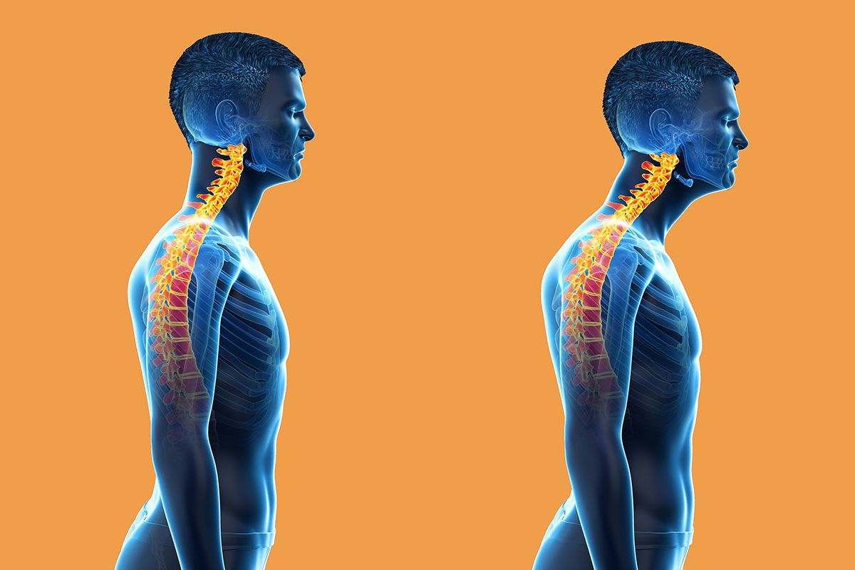 Can I Lose My Job if I Have Forward Head Posture?